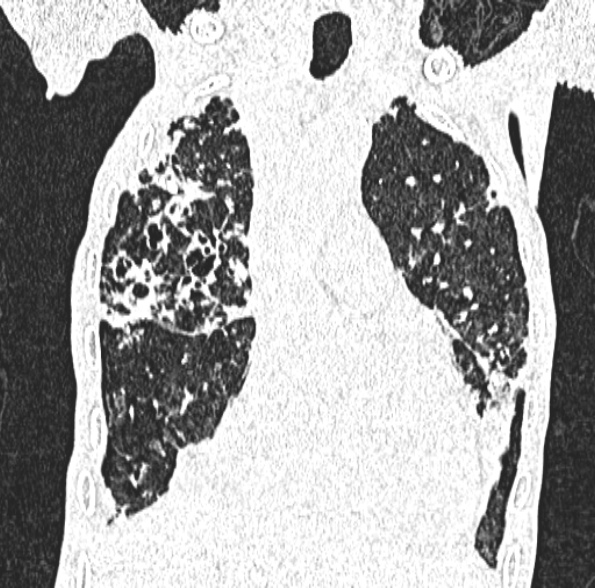 Aspergilloma- with Monod sign (Radiopaedia 44737-48532 Coronal lung window 193).jpg