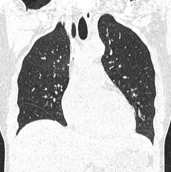 File:Aspergilloma (Radiopaedia 26223-26347 Coronal lung window 20).jpg