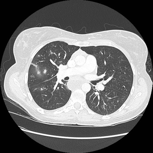 Aspiration pneumonia secondary to laparoscopic banding (Radiopaedia 18345-18183 lung window 50).jpg