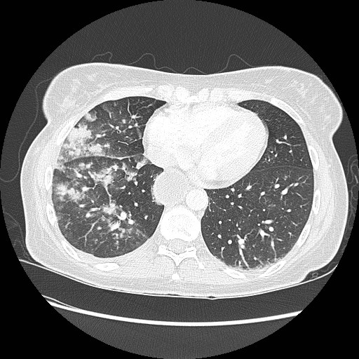 Aspiration pneumonia secondary to laparoscopic banding (Radiopaedia 18345-18183 lung window 78).jpg