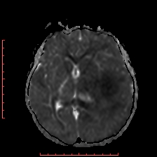 Astroblastoma (Radiopaedia 74287-85162 Axial ADC 33).jpg