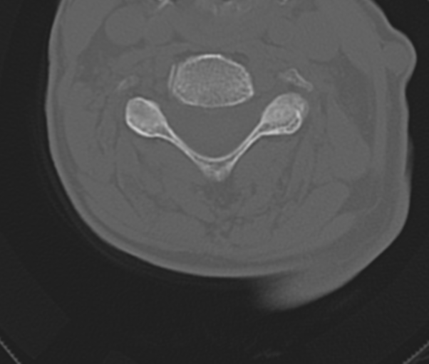 Atlanto-axial subluxation (Radiopaedia 36610-38176 Axial bone window 31).png