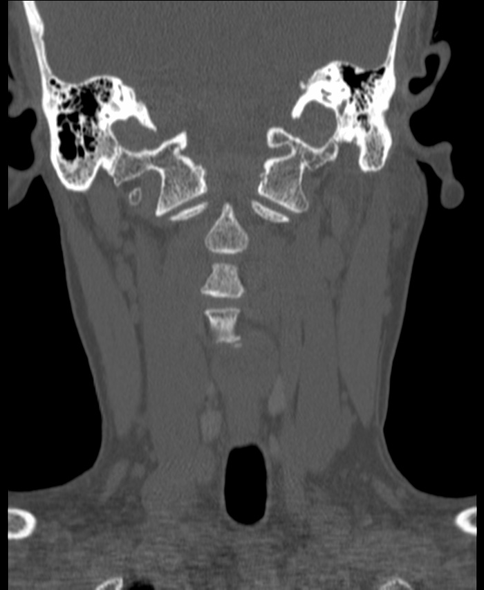 Atlanto-occipital assimilation with basilar invagination (Radiopaedia 70122-80188 Coronal bone window 68).jpg
