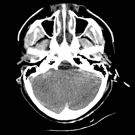 File:Atlanto-occipital dislocation (Radiopaedia 44648-48412 Axial non-contrast 14).jpg