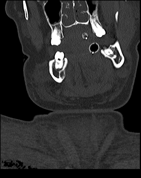 Atlanto-occipital dissociation - Traynelis type 1 (Radiopaedia 87570-103948 Coronal bone window 1).jpg