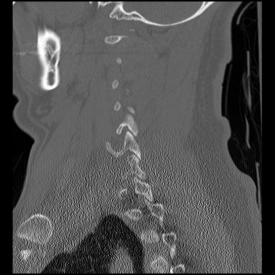 Atlanto-occipital dissociation injury (Radiopaedia 29274-29698 Sagittal bone window 43).png