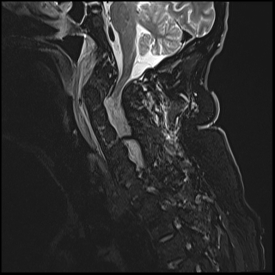 File:Atlas (type 3b subtype 1) and axis (Anderson and D'Alonzo type 3, Roy-Camille type 2) fractures (Radiopaedia 88043-104610 Sagittal STIR 4).jpg