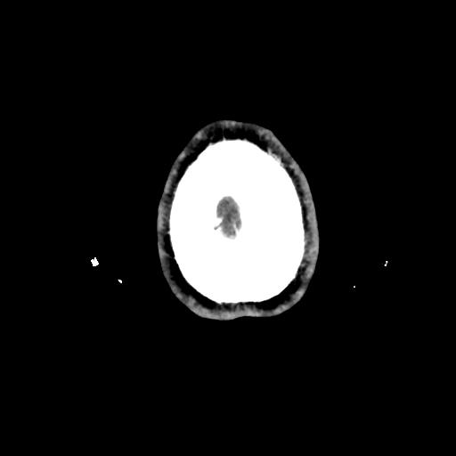 Atretic cephalocele (Radiopaedia 89782-106881 Axial with contrast 182).jpg