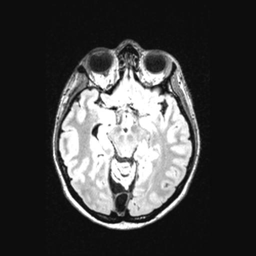 Atretic encephalocoele with inferior vermis hypoplasia (Radiopaedia 30443-31108 Axial 68).jpg