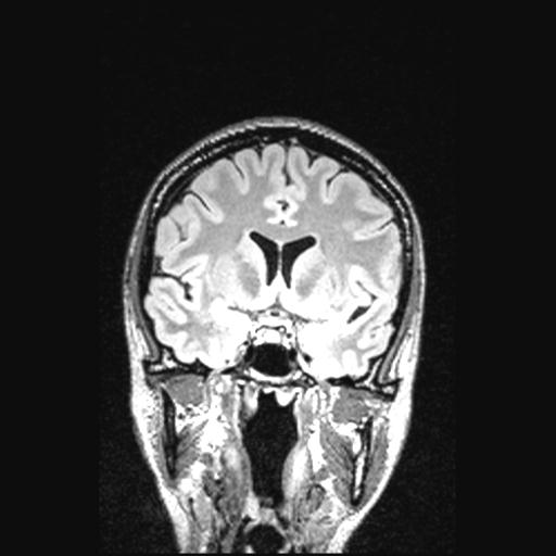 Atretic encephalocoele with inferior vermis hypoplasia (Radiopaedia 30443-31108 Coronal FLAIR 113).jpg
