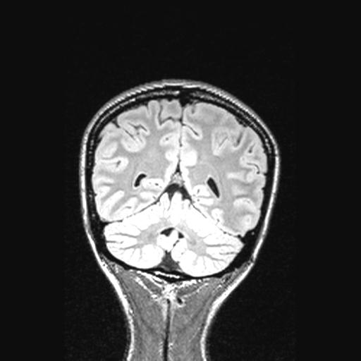 Atretic encephalocoele with inferior vermis hypoplasia (Radiopaedia 30443-31108 Coronal FLAIR 54).jpg