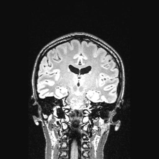 Atretic encephalocoele with inferior vermis hypoplasia (Radiopaedia 30443-31108 Coronal FLAIR 87).jpg