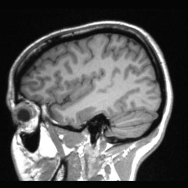 Atretic encephalocoele with inferior vermis hypoplasia (Radiopaedia 30443-31108 Sagittal T1 103).jpg
