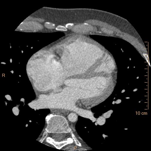 Atrial septal defect (upper sinus venosus type) with partial anomalous pulmonary venous return into superior vena cava (Radiopaedia 73228-83961 A 141).jpg