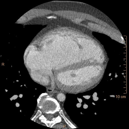File:Atrial septal defect (upper sinus venosus type) with partial anomalous pulmonary venous return into superior vena cava (Radiopaedia 73228-83961 A 186).jpg