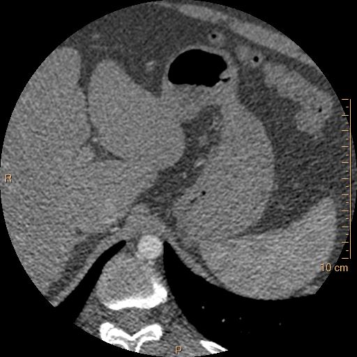 Atrial septal defect (upper sinus venosus type) with partial anomalous pulmonary venous return into superior vena cava (Radiopaedia 73228-83961 A 315).jpg