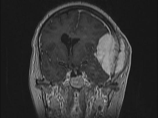 Atypical meningioma (Radiopaedia 62985-71406 Coronal T1 C+ 47).jpg