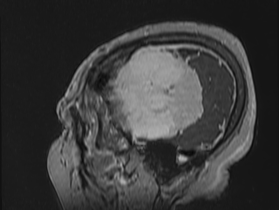 Atypical meningioma (Radiopaedia 62985-71406 Sagittal T1 C+ 86).jpg