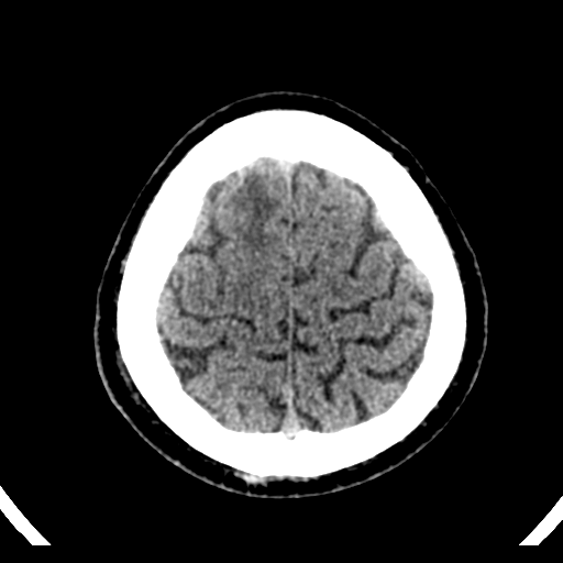File:Atypical meningioma (WHO grade II) with brain invasion (Radiopaedia 57767-64728 Axial non-contrast 39).png