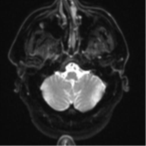 Atypical meningioma (WHO grade II) with brain invasion (Radiopaedia 57767-64729 Axial DWI 5).png