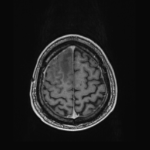 File:Atypical meningioma (WHO grade II) with brain invasion (Radiopaedia 57767-64729 Axial T1 C+ 42).png