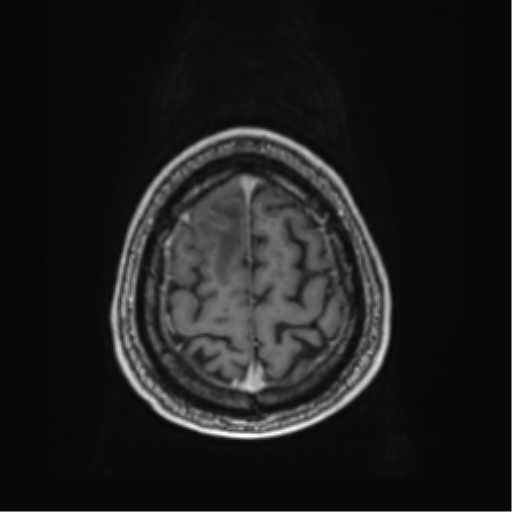 File:Atypical meningioma (WHO grade II) with brain invasion (Radiopaedia 57767-64729 Axial T1 C+ 44).png