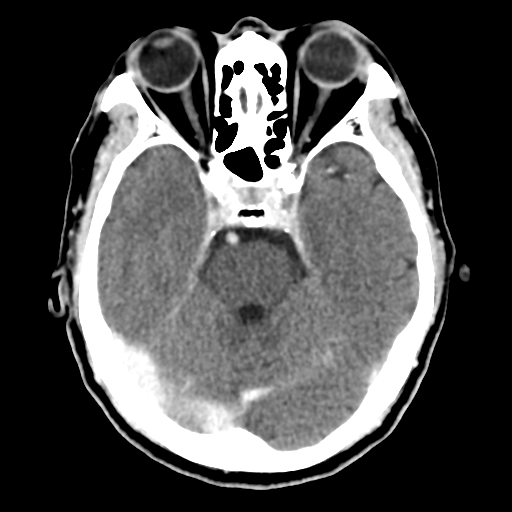 Atypical meningioma (WHO grade II) with osseous invasion (Radiopaedia 53654-59715 Axial C+ delayed 19).png
