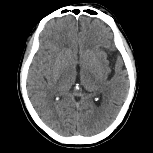 Atypical meningioma (WHO grade II) with osseous invasion (Radiopaedia 53654-59715 Axial non-contrast 27).png