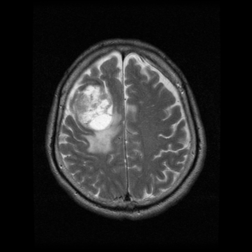 File:Atypical meningioma (WHO grade II) with osseous invasion (Radiopaedia 53654-59716 Axial T2 16).png
