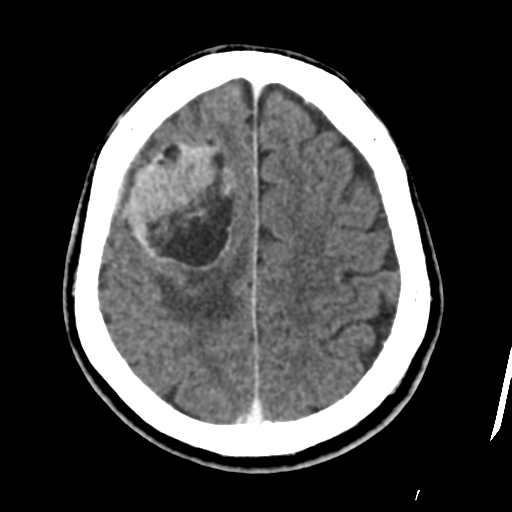 Atypical meningioma with skull invasion (Radiopaedia 34357-35649 Axial C+ delayed 40).png