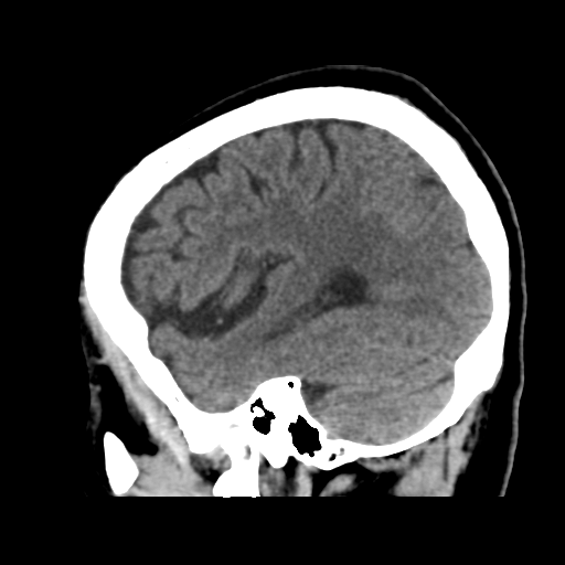 Atypical meningioma with skull invasion (Radiopaedia 34357-35649 E 41).png