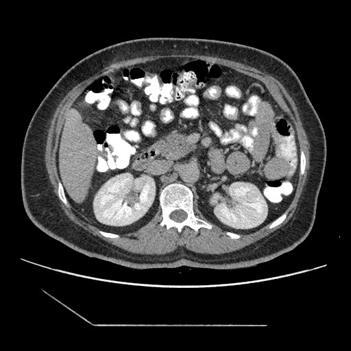 File:Atypical retroperitoneal lymphocoeles with large leiomyoma of uterus (Radiopaedia 32084-33024 A 16).jpg