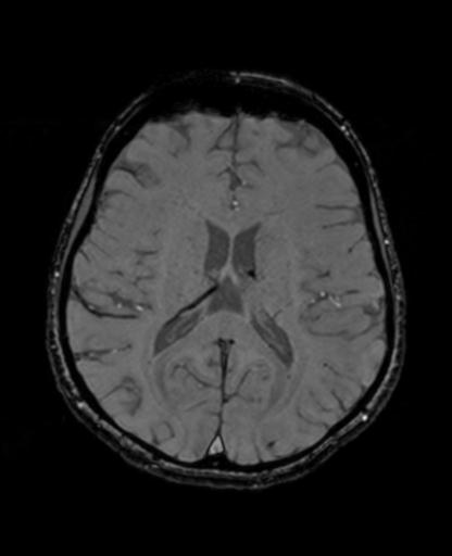Autoimmune limbic encephalitis (Radiopaedia 30363-31005 SWI - magnitude 46).jpg