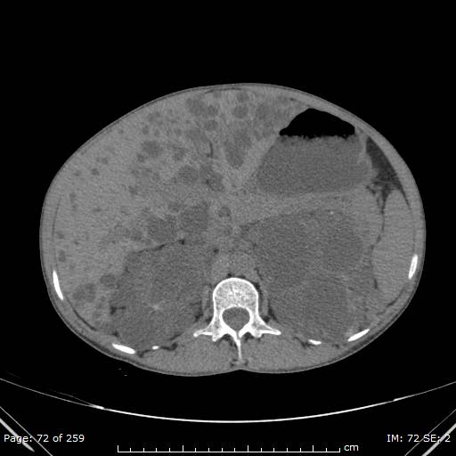 File:Autosomal dominant polycystic kidney disease (Radiopaedia 44122-47684 Axial 43).jpg