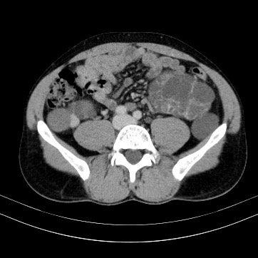 Autosomal dominant polycystic kidney disease (Radiopaedia 66349-75582 B 68).jpg