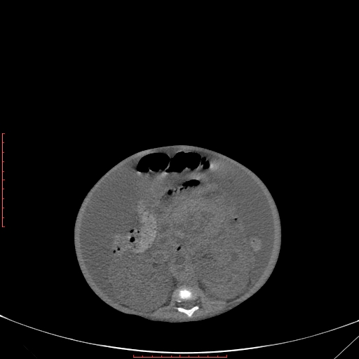 Autosomal recessive polycystic kidney disease associated with Caroli disease (Radiopaedia 61932-69984 B 223).jpg