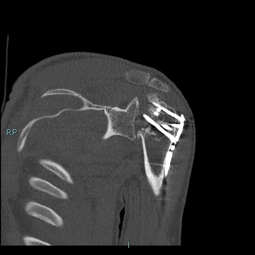 Avascular necrosis after fracture dislocations of the proximal humerus (Radiopaedia 88078-104655 Coronal bone window 76).jpg