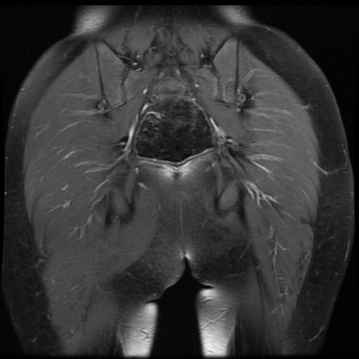 File:Avascular necrosis of the hip (Radiopaedia 29563-30067 I 16).jpg
