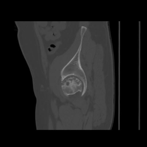 Avascular necrosis of the hip (Radiopaedia 61503-69467 B 47).jpg