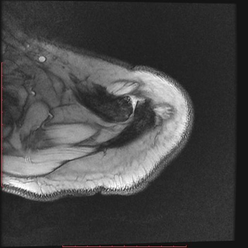 File:Avulsion fracture - greater tuberosity of humerus (Radiopaedia 25457-25703 Axial Gradient Echo 2).jpg