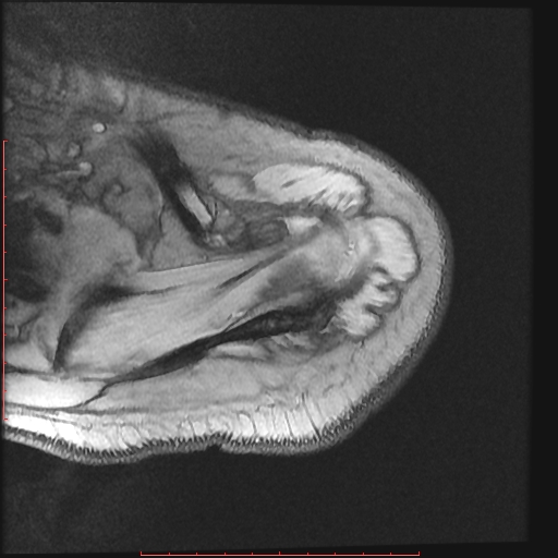 File:Avulsion fracture - greater tuberosity of humerus (Radiopaedia 25457-25703 Axial Gradient Echo 4).jpg