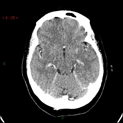 Azygos anterior cerebral artery (Radiopaedia 51987-57833 A 25).jpg