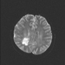 Balo concentric sclerosis (Radiopaedia 50458-55940 Axial DWI 31).jpg