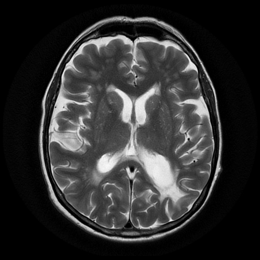 File:Balo concentric sclerosis (Radiopaedia 53875-59982 Axial T2 14).jpg