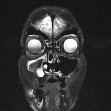 File:Base of skull chondrosarcoma (Radiopaedia 30410-31070 Coronal T2 fat sat 4).jpg