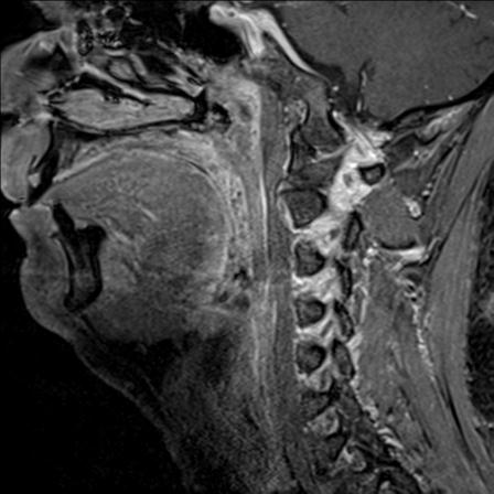 Base of tongue squamous cell carcinoma (Radiopaedia 31174-31884 F 104).jpg