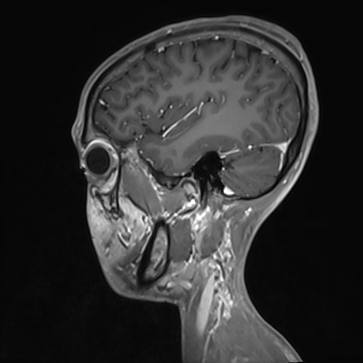 Basilar artery perforator aneurysm (Radiopaedia 82455-97733 G 114).jpg