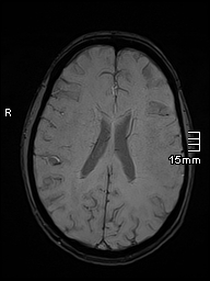 Basilar artery perforator aneurysm (Radiopaedia 82455-99523 Axial SWI 41).jpg