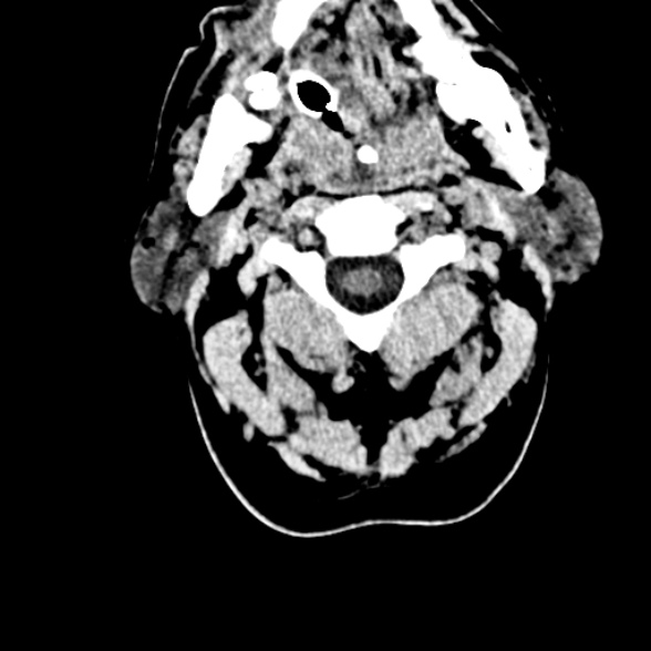 Basilar artery thrombosis (Radiopaedia 53351-59352 Axial non-contrast 3).jpg