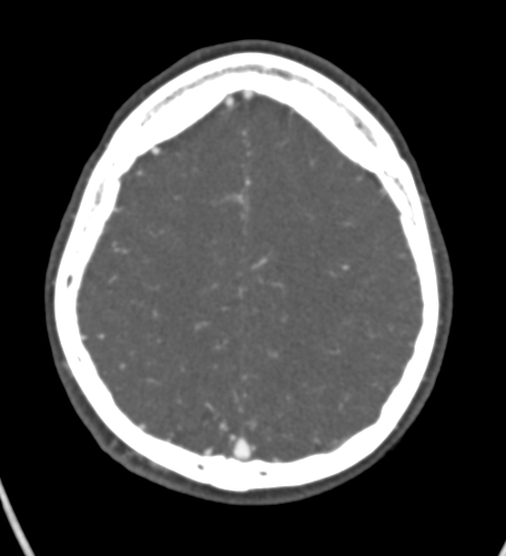 Basilar tip aneurysm with coiling (Radiopaedia 53912-60086 A 114).jpg